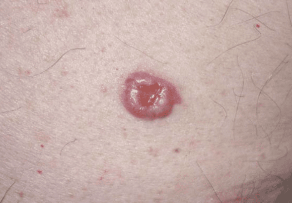 Basal Cell Carcinoma