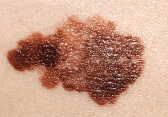 Melanoma